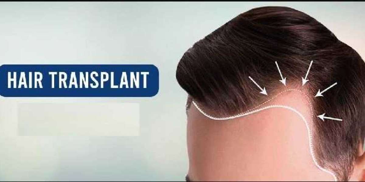 The Ultimate Guide to Hair Transplant in Korba: What to Expect