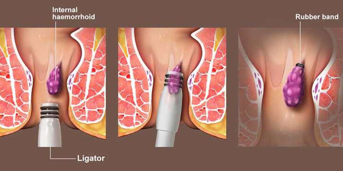 Exploring Non-Surgical Treatment Options for Fissures and Piles: Your Guide