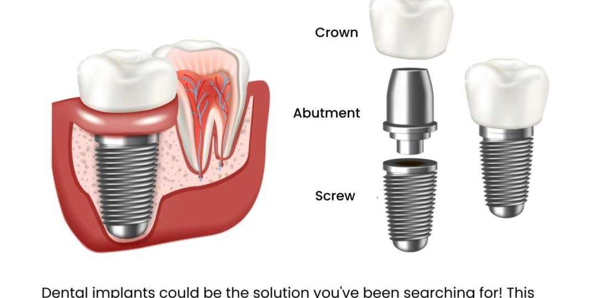 Discover the Best Dental Implants in Bangalore for a Perfect Smile