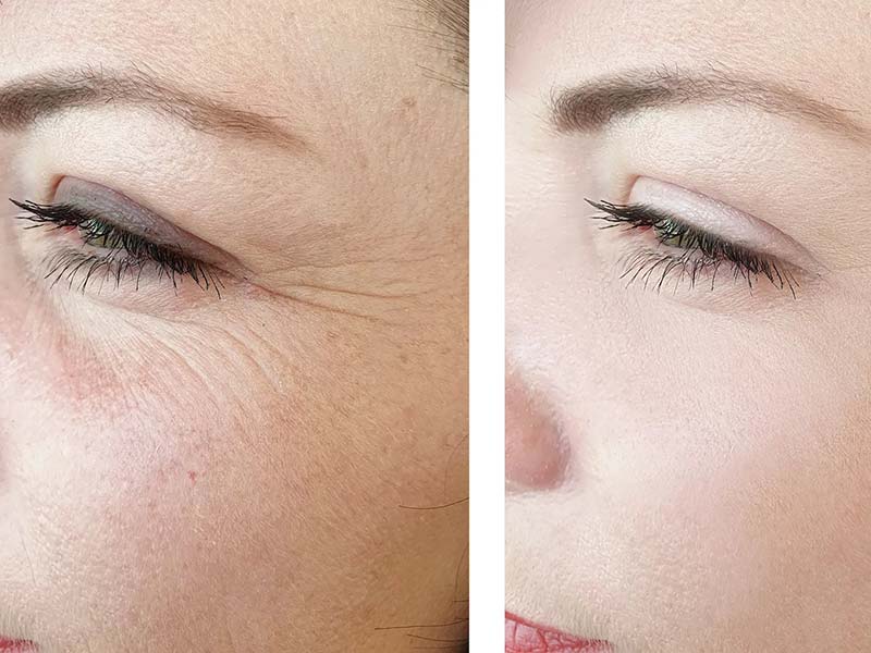 Anti-Wrinkle Injections: Reveal Youthful Radiance with Expert Care