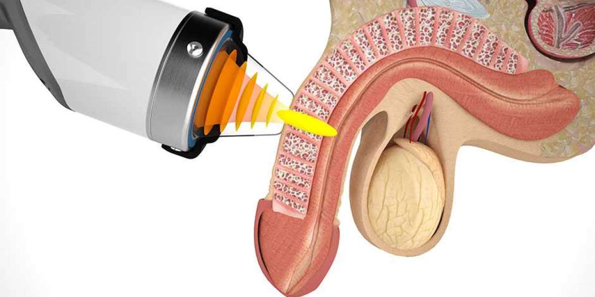 Is Shockwave Therapy a Safe and Effective Solution for ED?