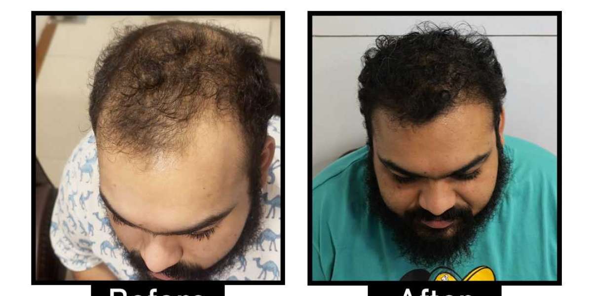 How to Choose the Best Hair Transplant Clinic for You?