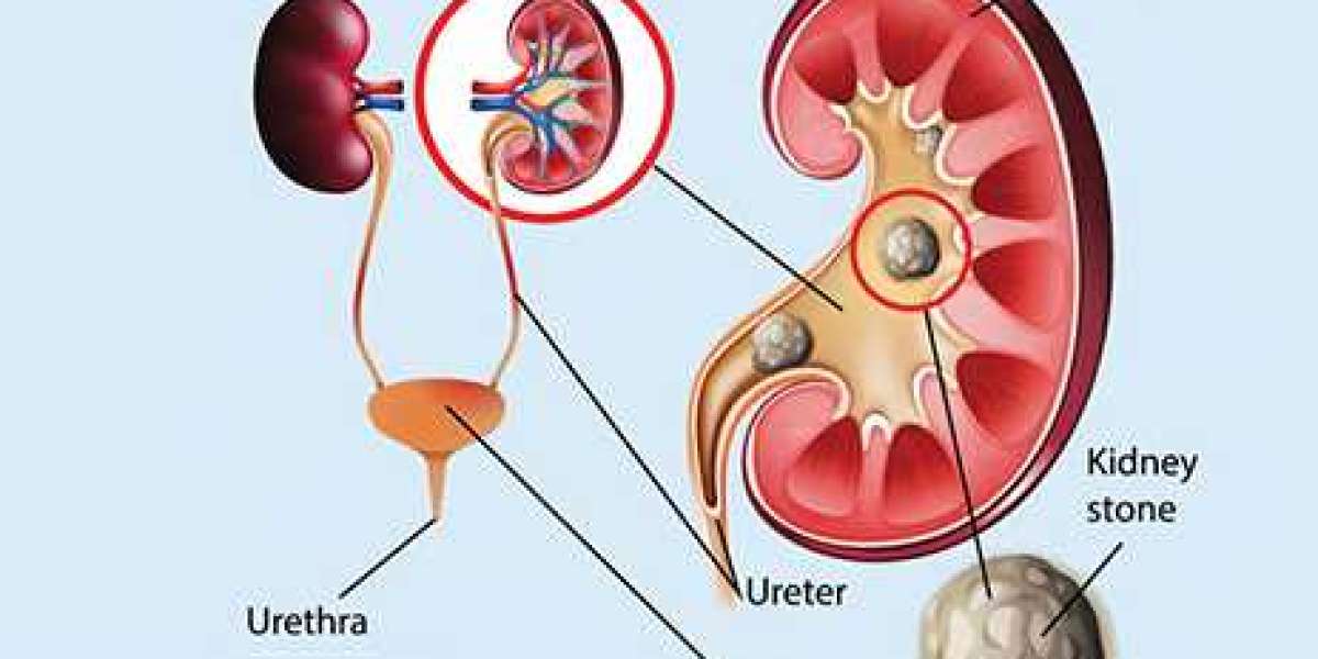 Transform your life with effective Kidney Stone Treatment at Swanand Kidney Clinic in Bhosari!